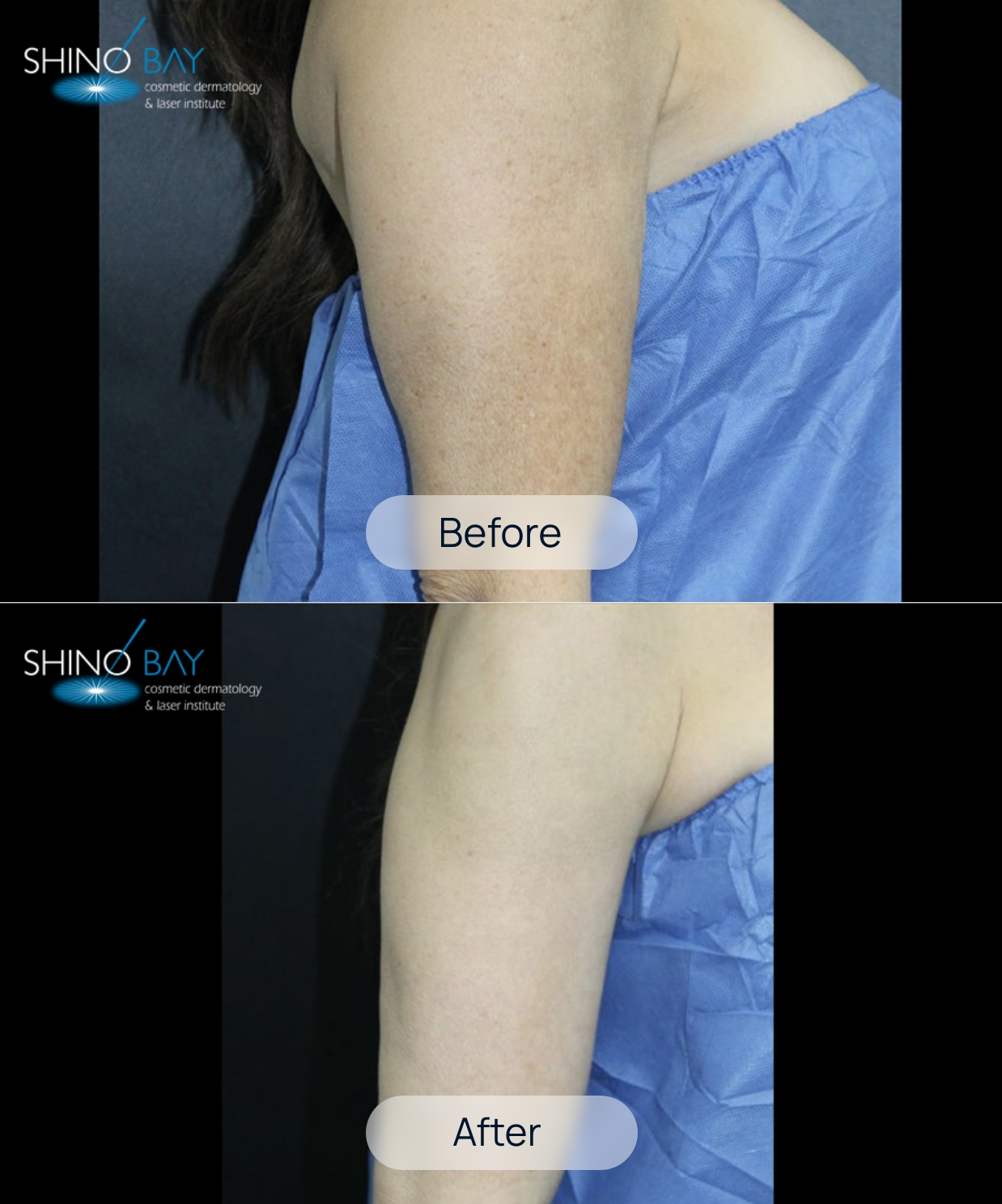 BA-Shino-Bay-Treament-1