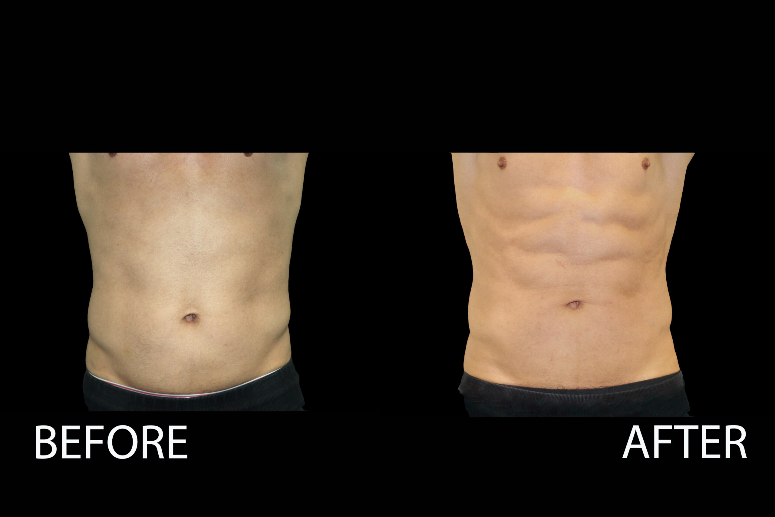 eon body contouring before and after