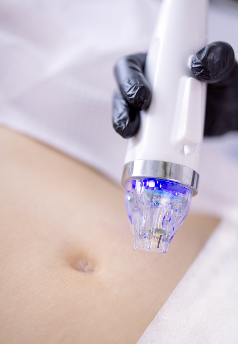 Rf-microneedling-2-shino-bay-2