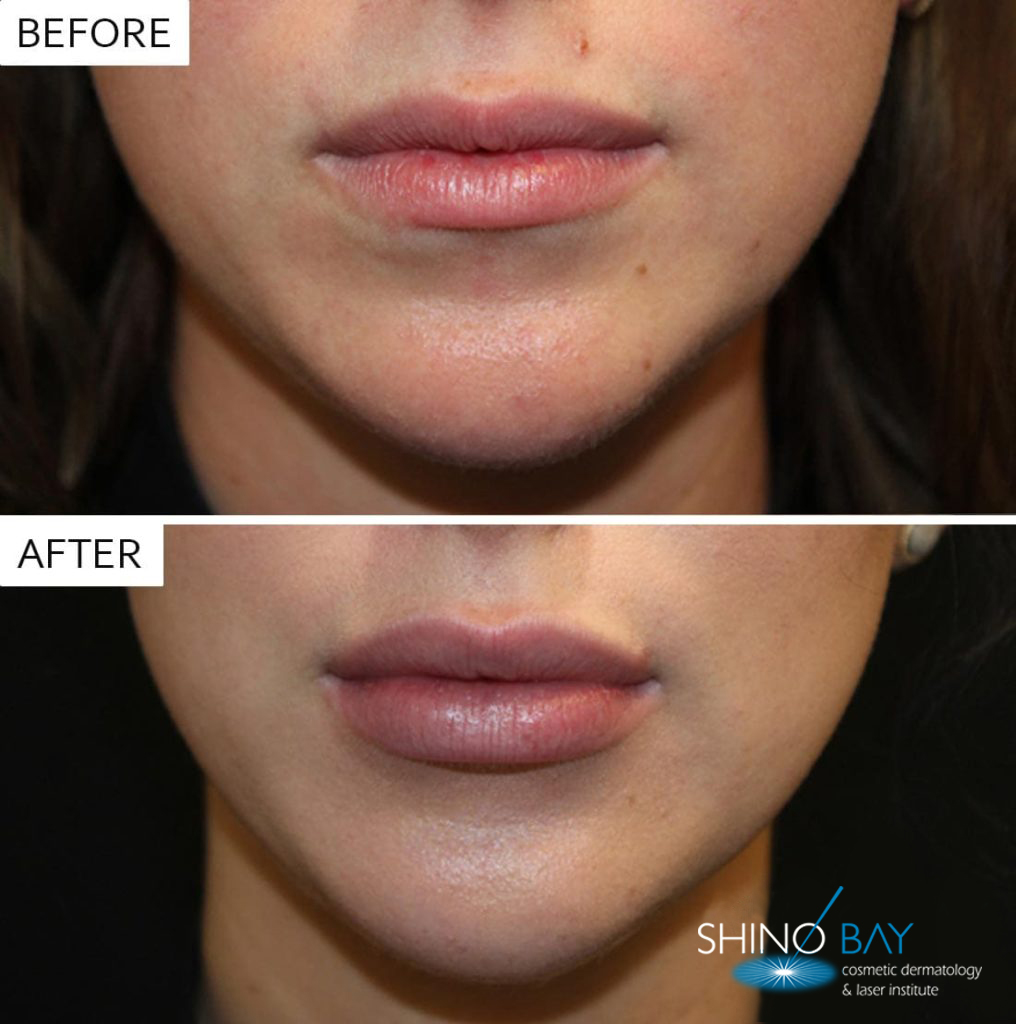 juvederm-lips-1016x1024-1
