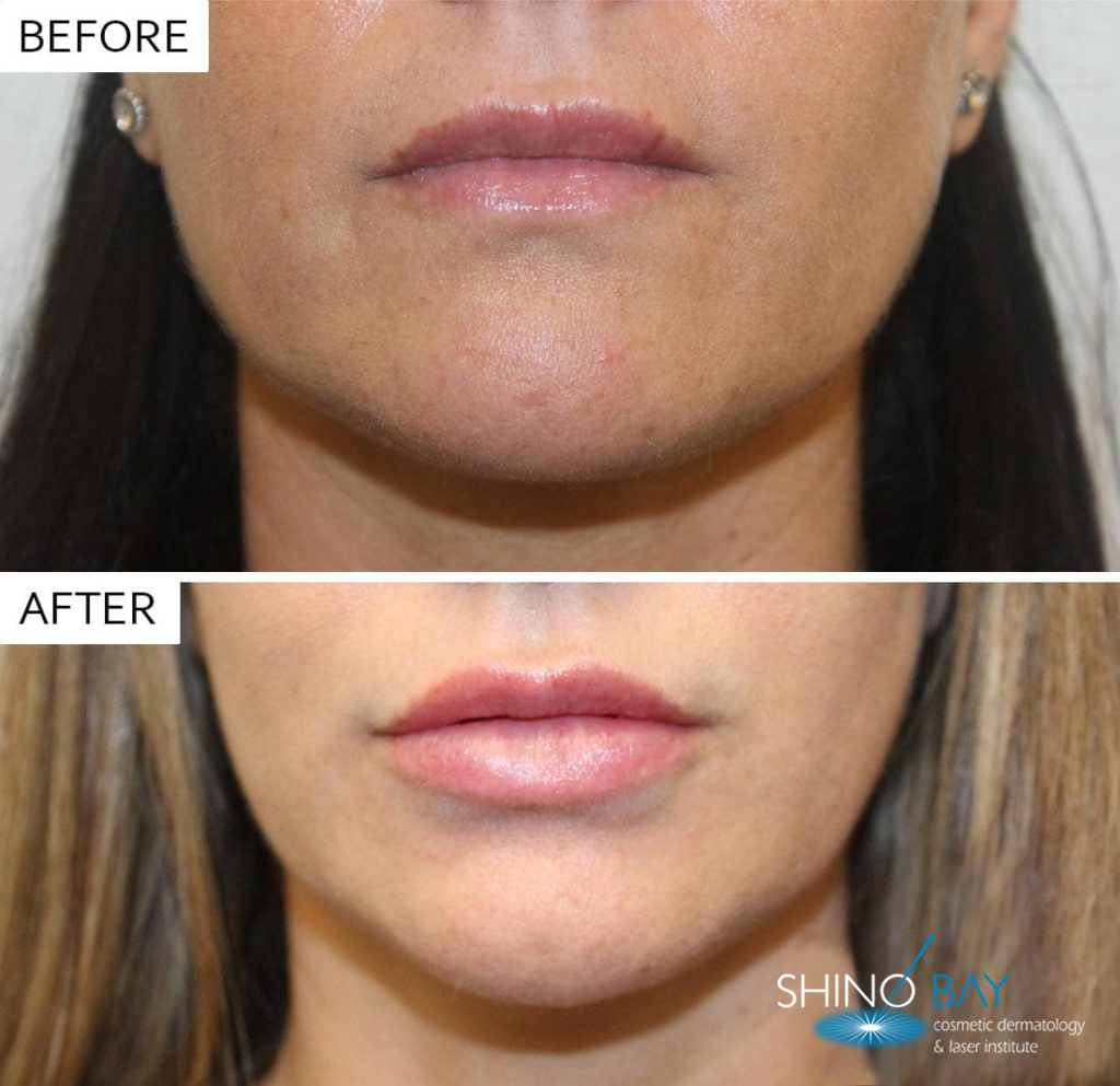 juvederm-lips-2-1024x993-1