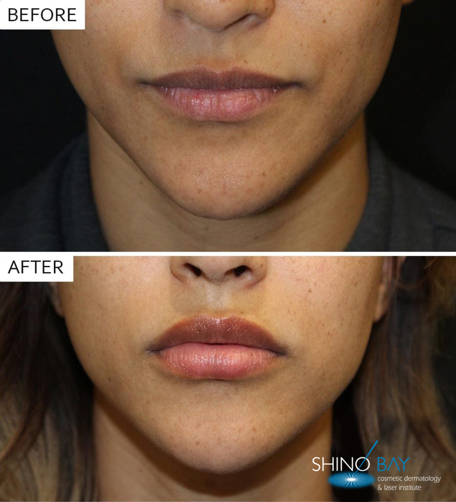 juverderm-lips-3-931x1024-1