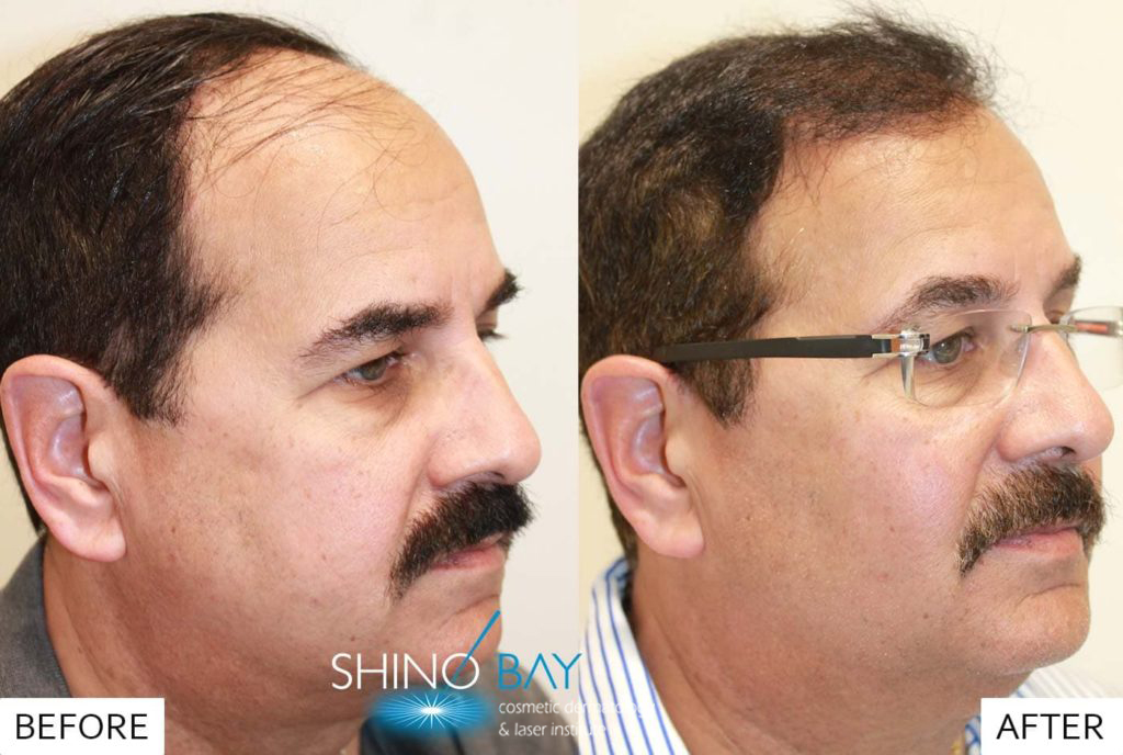 neograft-before-9-months-after-soro