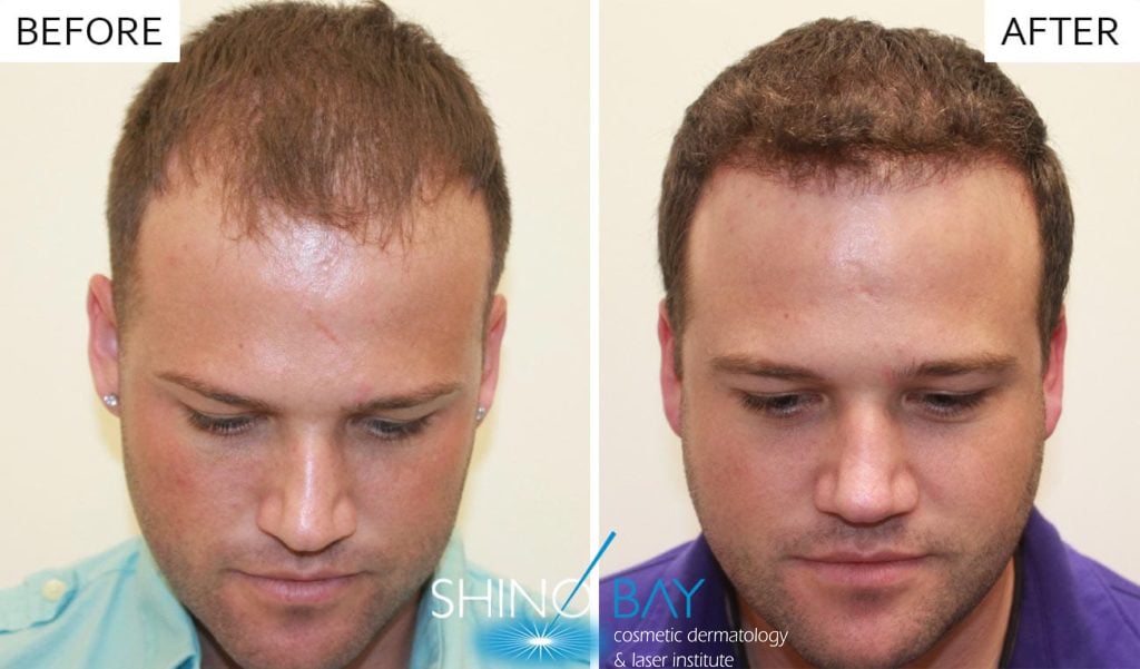 neograft-before-after-1024x601-1