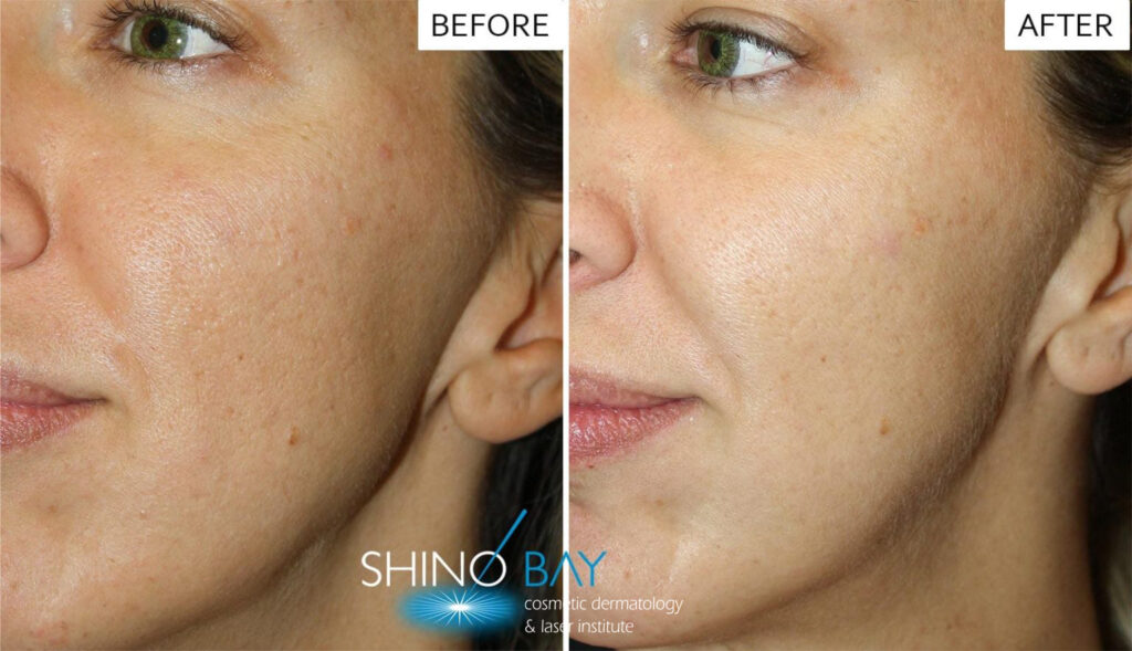 skinpen-before-after-1536x884-1-1024x589