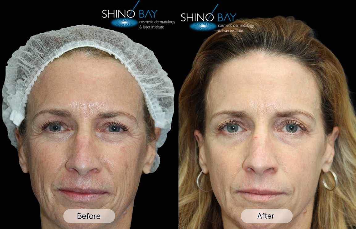 treatment-before-after-1