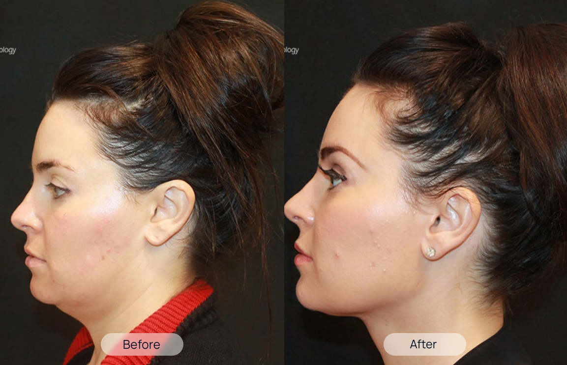 treatment-before-after-2-4