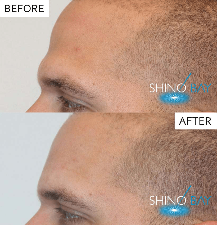 Valuma-1-min Voluma Cheek Filler