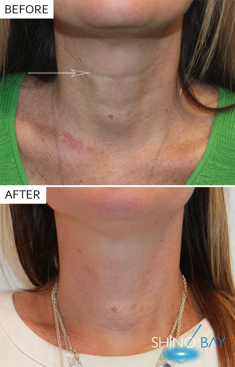 Belotero Nasolabial Fold Filler has Several Benefits!Shino Bay