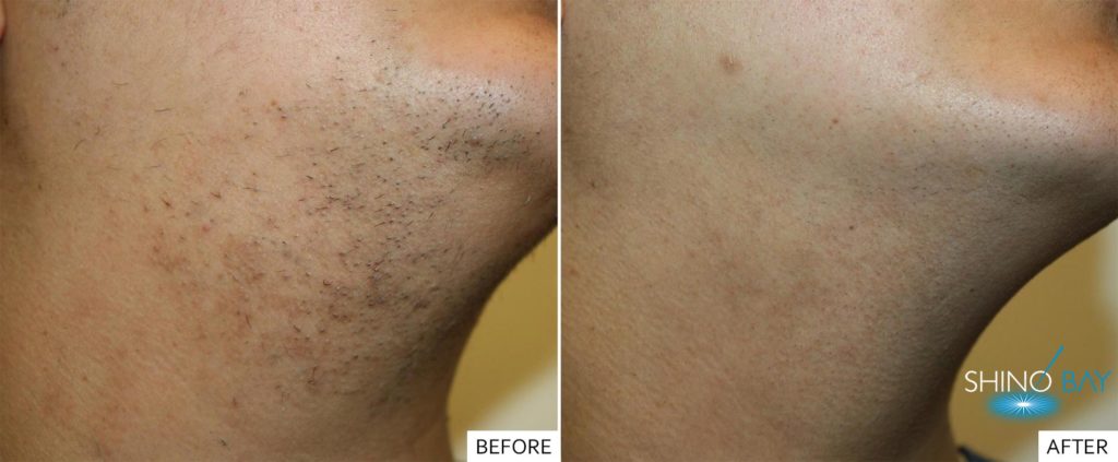 The Laser Hair Removal is Safe and Painless Procedure -Laser Hair Removal  is a Safe and Painless Procedure