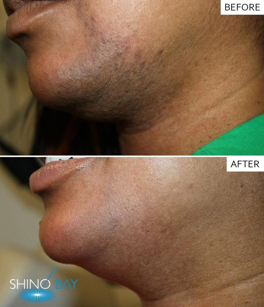 The Laser Hair Removal is Safe and Painless Procedure -Laser Hair Removal is a Safe and Painless Procedure The Laser Hair Removal is Safe and Painless Procedure -Laser Hair Removal is a Safe and Painless Procedure