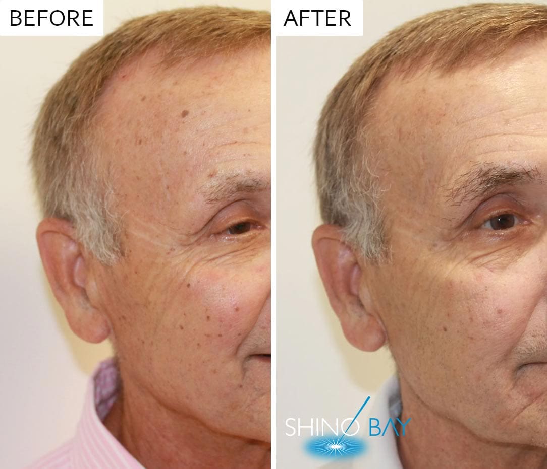 Brown Spots on Skin