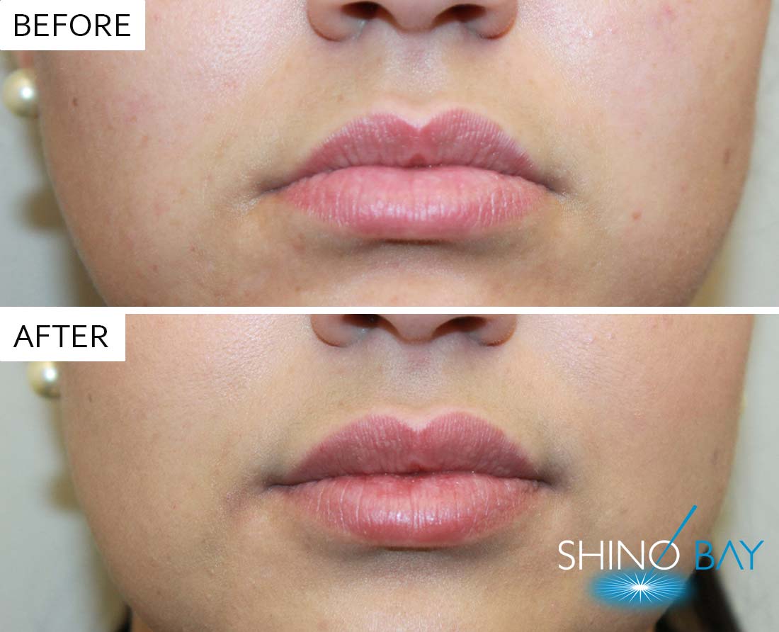 Juvederm Ultra Plus Lip Filler Boosts the Shape of your Lips