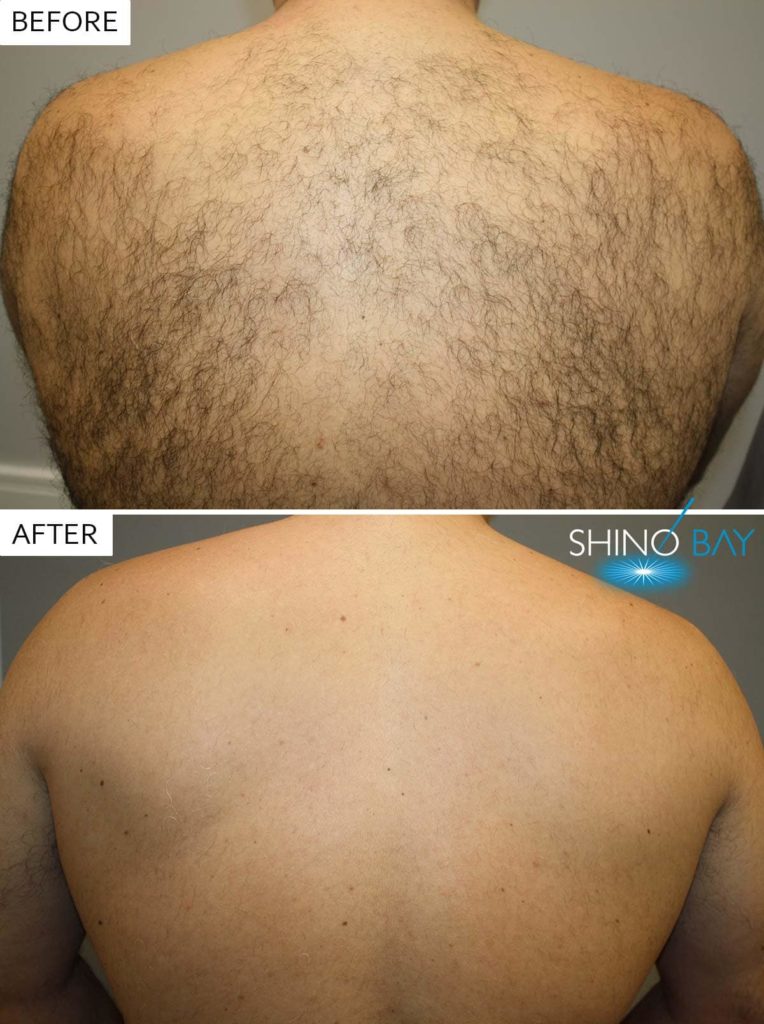 The Laser Hair Removal is Safe and Painless Procedure -Laser Hair Removal is a Safe and Painless Procedure The Laser Hair Removal is Safe and Painless Procedure -Laser Hair Removal is a Safe and Painless Procedure
