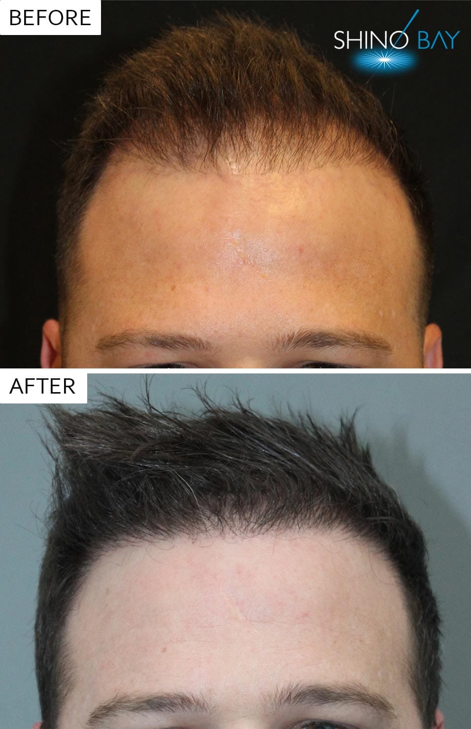 A Neograft hair transplant gets your hair back! A Neograft hair transplant gets your hair back!