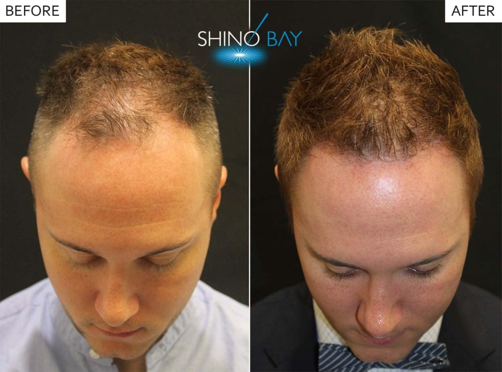 A Neograft hair transplant gets your hair back!