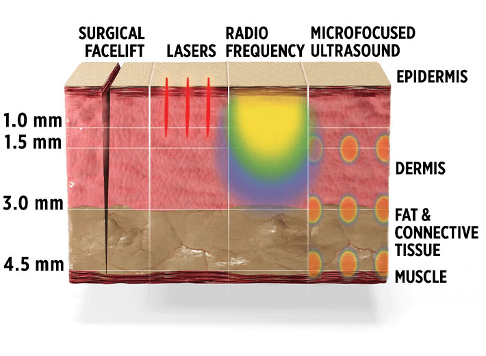 What Can You Expect Before, During, and After an Ultherapy Treatment?