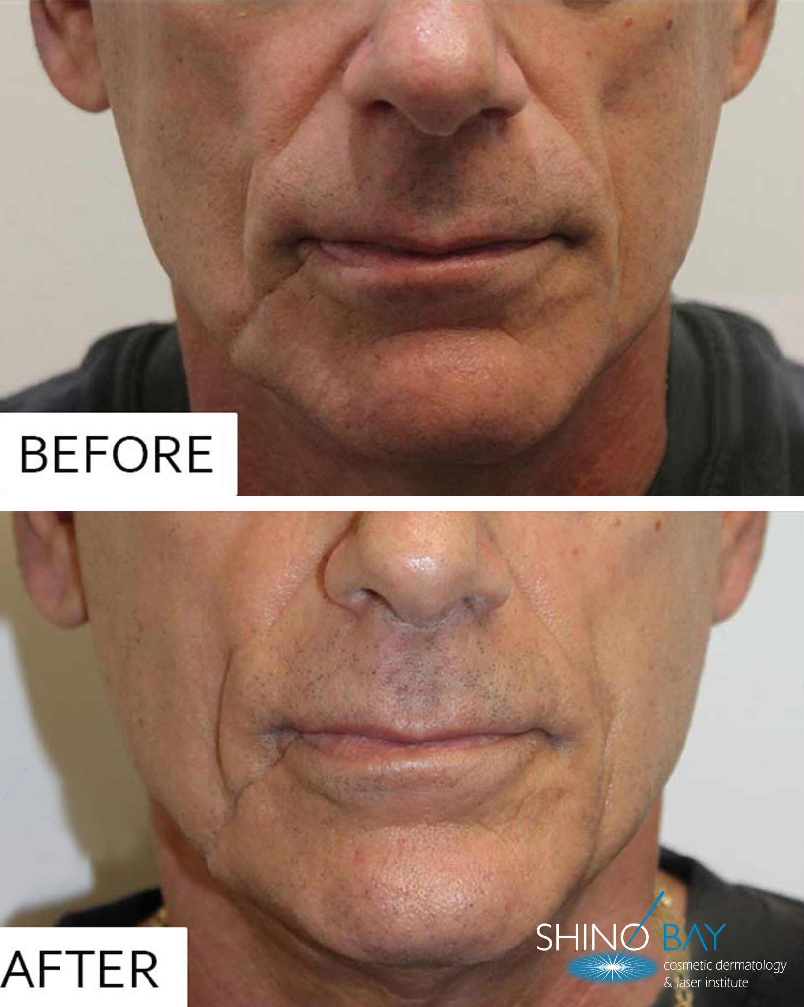 Sculptra Before and After