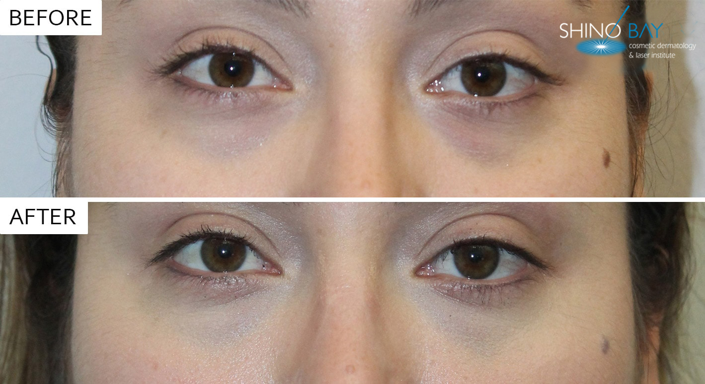 Threads Under Eyes Before and After
