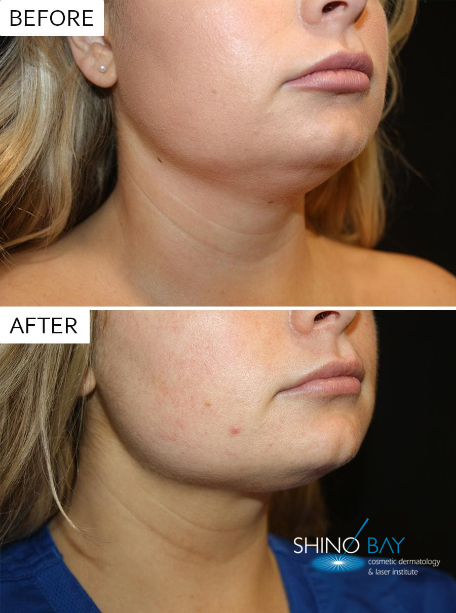 CoolSculpting Elite Chin Before and After