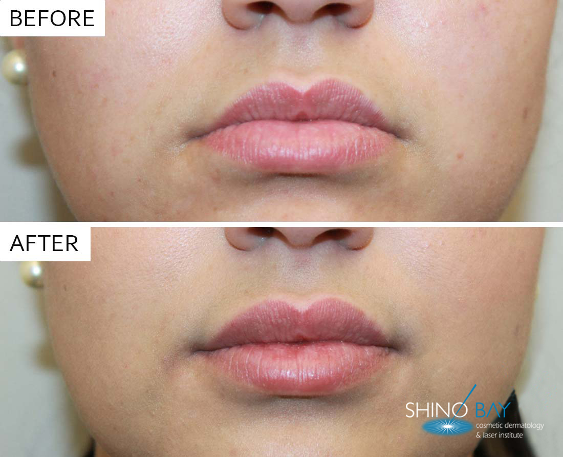 Juvederm Ultra Before and After