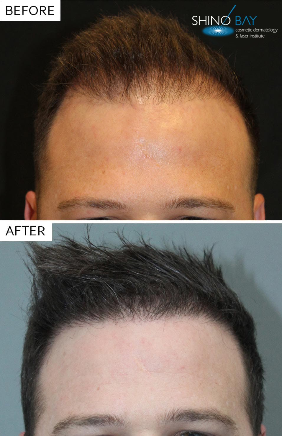 Neograft Hair Transplant Before and After
