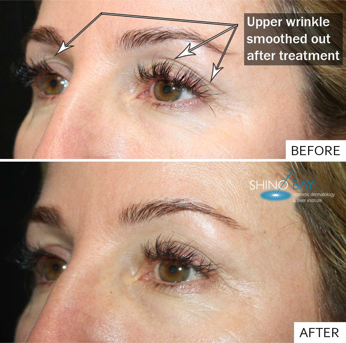 Ultherapy Before and After